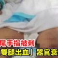 處理蝦尾手指被刺婦「雙腿出血」器官衰竭亡