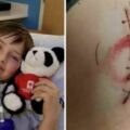 8歲男童騎腳踏車摔倒「縫了傷口」，8天後「傷口反噬」把他右半邊身體都吃掉了！