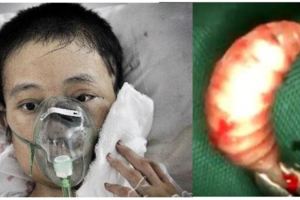 「爸爸，我覺得我活不成了，我將死去」22歲女孩臉部潰爛，醫生竟取出兩百多條蛆蟲！死因竟然是？