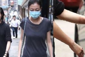 留院兩個月的卓林在醫生及社工等人士批准下，日前終於出院返家，重投母親懷抱。幾十條自殘傷痕觸目驚心！