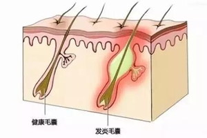 不到1塊錢的食鹽竟然是祛痘秘方！！！太厲害了！