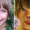 只因為打翻牛奶，女孩3個月大時被浣熊「吃掉半張臉」毀容，重建過後越來越漂亮。