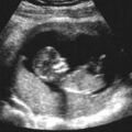 婦科醫生發現來婦產科的17歲小女生已懷孕14週，但看著超音波圖，卻說不出恭喜！