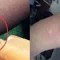 蚊子咬了腫一包奇癢難忍？越抓越癢，教你止癢方法，60秒後止癢去痕！