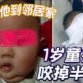 阿嬤牽他到鄰居家1歲童被狗咬掉半邊臉