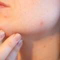 臉發黃是肝炎引起的黃疸所致？會不會傳染給孩子，一文告知