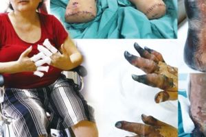 「醫生害我沒手腳」剩下兩隻發黑的手指等待自然脫落，而其餘手指已經無法操作