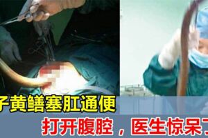 強國男信偏方，半米黃鱔塞肛門通便險死，打開腹腔醫生，這條黃鱔竟然已經~