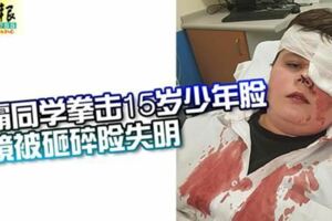 悲！惡霸同學拳擊15歲少年臉眼鏡被砸碎險失明！