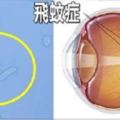 「飛蚊症」無法根治的殘酷真相，教你延緩玻璃體老化的飲食療法！