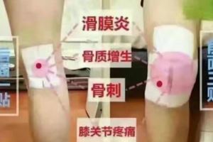 老倪祖三貼—–滑膜炎、膝蓋疼