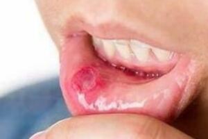 吃水果能治好口腔潰瘍嗎？營養師：3種原因會加重你的口腔潰瘍