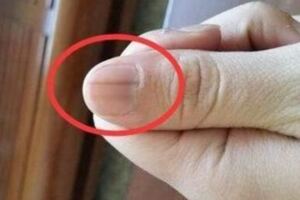 如果手指指甲上出現這條線，要當心是惡癌來襲！