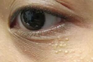 眼睛周圍的小粒粒，真是眼霜惹的禍？最好的消除方法是……