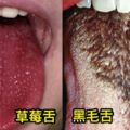 8張超驚悚「舌頭突變」代表身體健康出現問題，舌頭長毛是要再超級進化？！#6紫舌頭可能就沒救了...