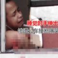 睡覺時手伸出車窗外慘遭公車撞斷痛哭失聲