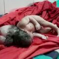 罕見！印度產婦生下畸形「三頭女嬰」