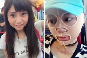 她曾是可愛的護理系女孩，卻因為八仙塵爆案讓68%的皮膚沒了…但她仍保持「這種精神」，值得所有人學習！