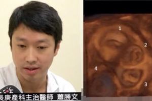 日前台灣一名女子因急性腹痛送醫後竟然檢查出驚喜，醫生一看到熒幕裡的畫面都覺得非常不可思議！