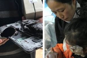 三星手機又傳爆炸　貴州5歲女臉手燒傷恐毀容