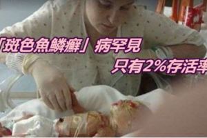 男童全身長滿魚鱗泡漂白水才能活下