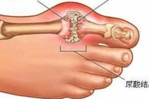 痛風性關節炎急性期該不該降尿酸？快看看！