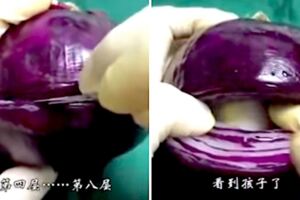 洋蔥「模擬剖腹產」太真實引瘋傳　無數網友痛到落淚：媽媽太偉大了