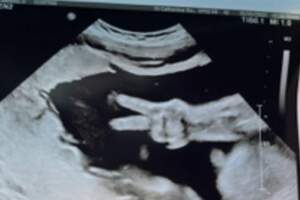 醫生在拍！媽媽產檢「胎兒突然比YA」　奇蹟超音波照曝光