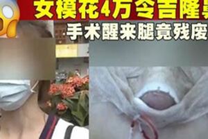 女模花4萬令吉隆鼻手術醒來腿竟殘廢了