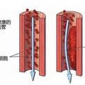 6個信號暗示你，血栓出現了，5種天然食物，是抗血栓「高手」