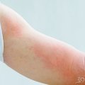 為什麼好好的皮膚會長蕁麻疹？這6個因素是「原罪」！