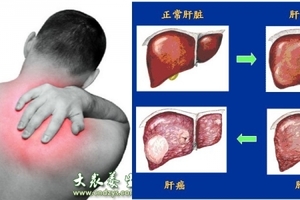 他不顧右肩酸痛，結果等發現時，「肝」已經爛到不能再爛，連醫生都束手無策，後悔莫及！