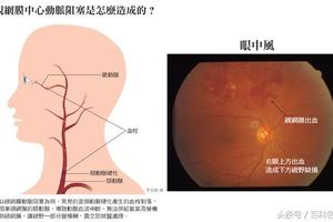 警惕！中老年人視網膜動脈阻塞的早期信號！可造成永久失明！