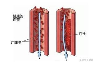 6個信號暗示你，血栓出現了，5種天然食物，是抗血栓「高手」