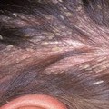 這幾個現象說明頭髮有蟎蟲！看看你有嗎？該要怎麽去除？