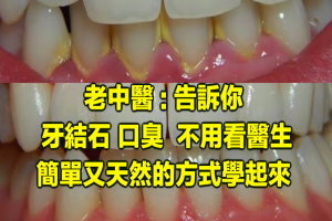 老中醫 告訴你: 牙結石、口臭 不用看醫生, 簡單又天然的方式學起來 ! 