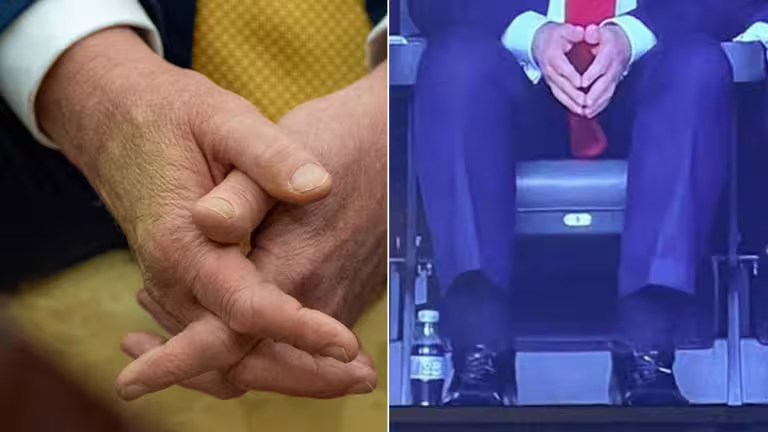 美國總統川普陸續被拍到手部瘀青、腿部腫脹的畫面,引發外界對他健康狀況的擔憂。(圖/達志影像美聯社、翻攝自X@@Jyndaru) 美國總統川普陸續被拍到手部瘀青、腿部腫脹的畫面,引發外界對他健康狀況的擔憂。(圖/達志影像美聯社、翻攝自X@@Jyndaru)