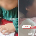 筷子插進插座孔　女童「9根手指切除」痛哭：不能畫畫了