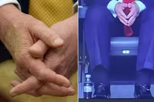 川普「腿腫手瘀青」照片瘋傳！ 網友驚呼：英國女王死前也這樣