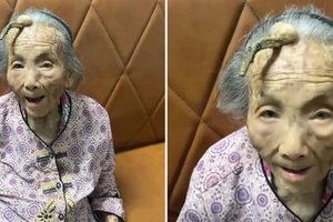 107歲老奶奶「額頭長角」！兒孫嗨喊「長壽象徵」　醫一看驚：快切掉