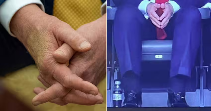 川普「腿腫手瘀青」照片瘋傳！ 網友驚呼：英國女王死前也這樣