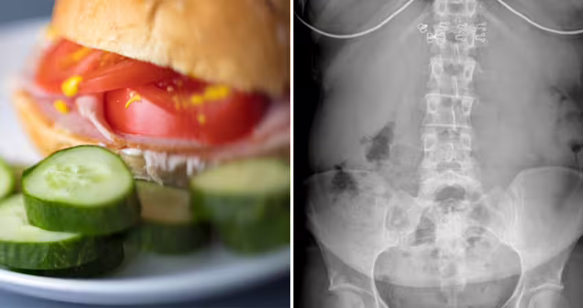 「常吃1早餐」引發大腸癌　研究證實：強力致癌物