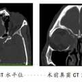 眼球突出、視力下降 原來是鼻竇里長了個大囊腫