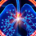 肺癌患者血常規指標特徵分析
