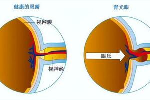 中醫眼裡的「致盲殺手」青光眼