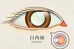 關於白內障的五問五答