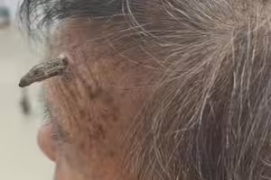 98歲嬤「頭上長角」！竟「自行剪斷」急送醫　驚人真相曝光