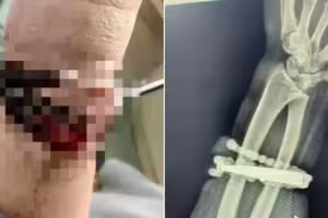 女子戴手鐲10年不摘!「嵌進肉裡」醫嚇傻 女子戴手鐲10年不摘!「嵌進肉裡」醫嚇傻