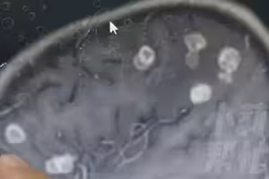 大掃除完…6歲女童高燒17天！檢查驚「腦袋被啃20個洞」元凶曝光