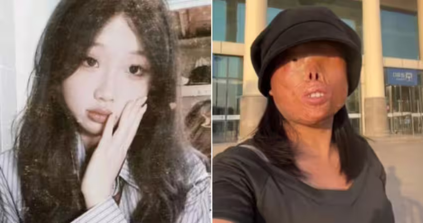 遭恐怖情人毀掉五官！23歲女子樂觀擁抱人生 「找到真愛」創業超成功